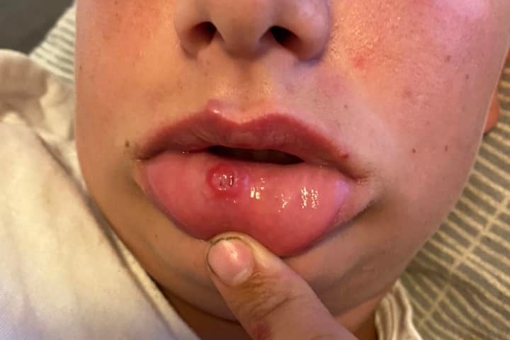 A close up of a boy nose down holding his lip to show a wound to the inside of his lip.