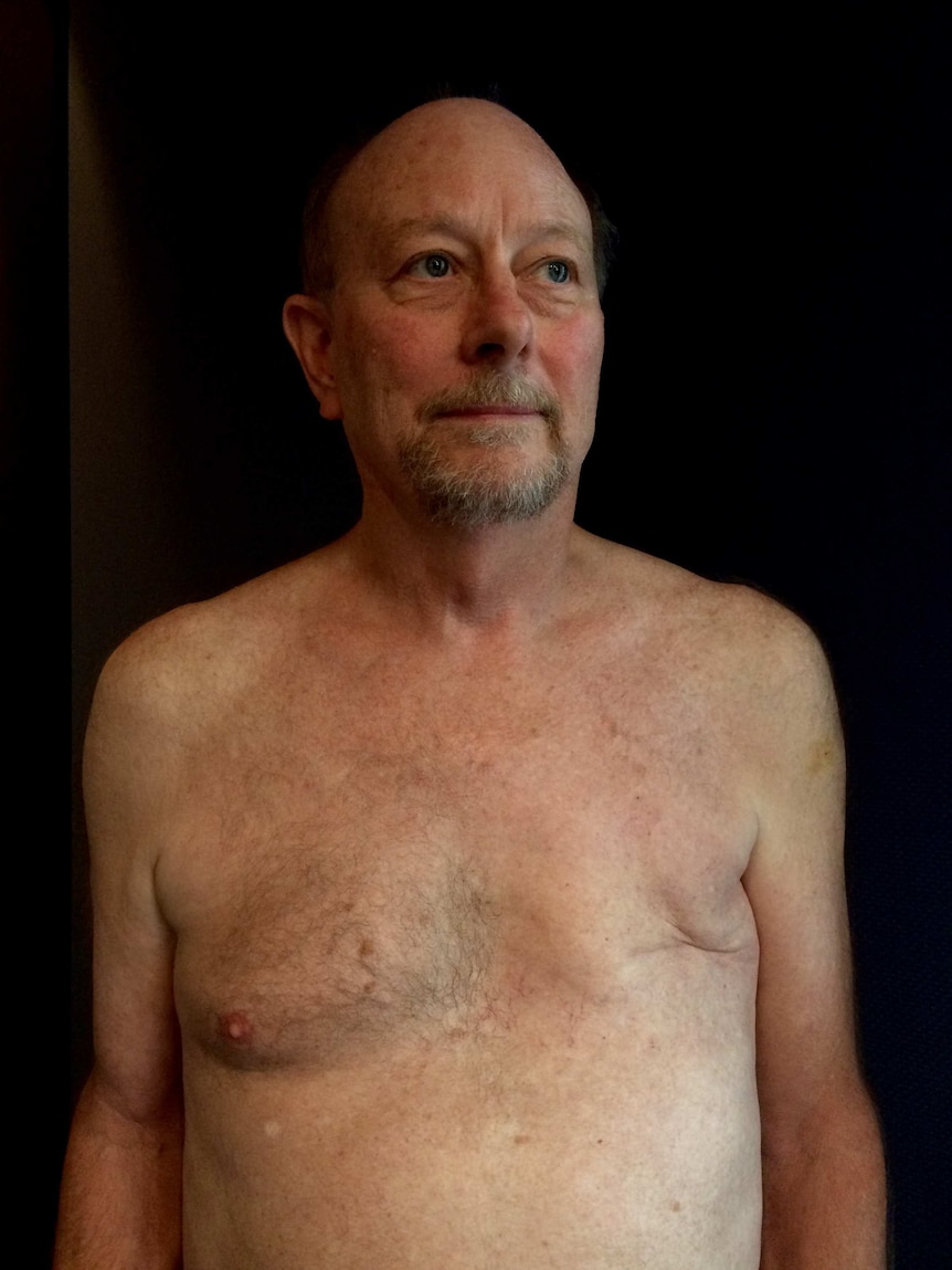A man without a shirt on shows his masectomy scar after breast cancer surgery
