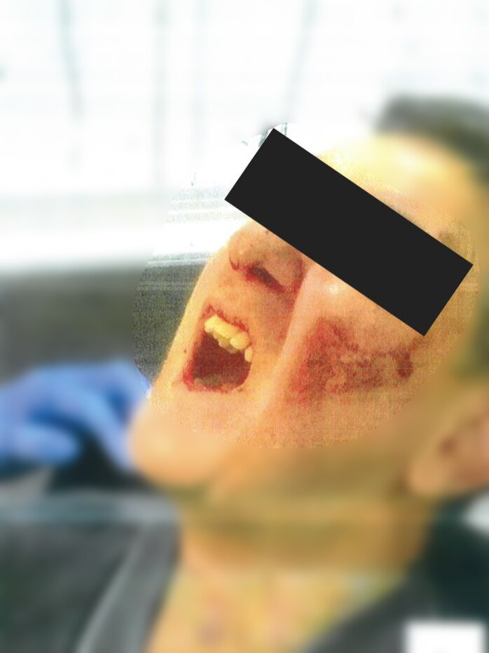 An unidentifiable man apparently crying out in pain with blood on his cheek.