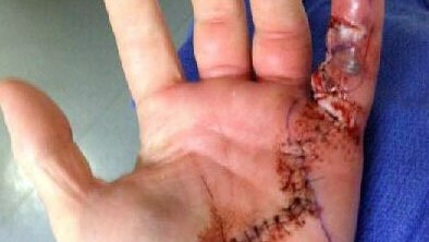 Unidentified firefighter's infected hand