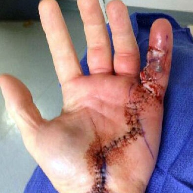 Unidentified firefighter's infected hand