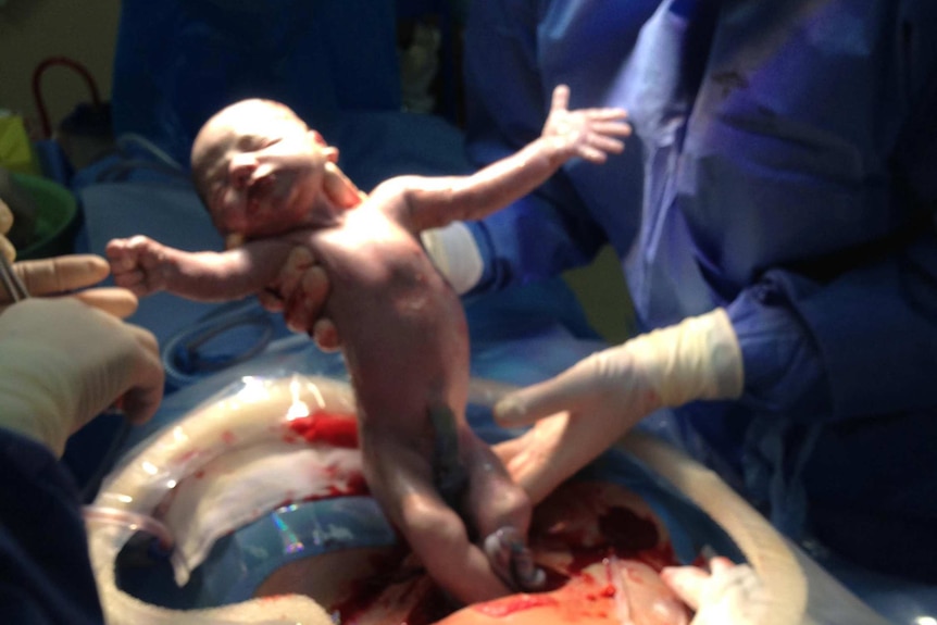 A baby is born in a caesarean  birth.
