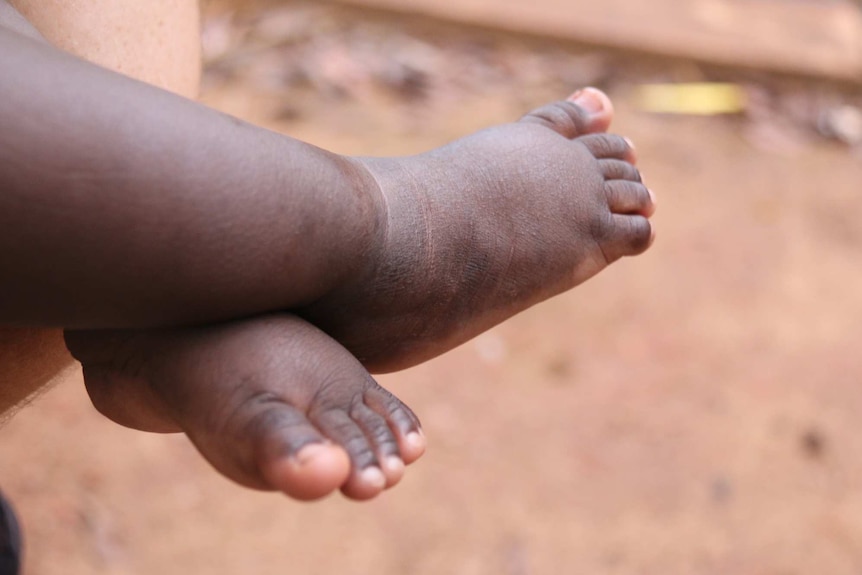 The feet of an Aboriginal infant
