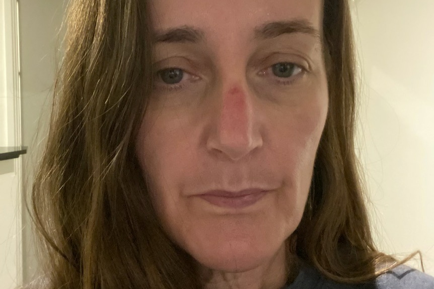 A close-up, cropped image of nurse Renee Freeman with a mark on her nose from wearing PPE.
