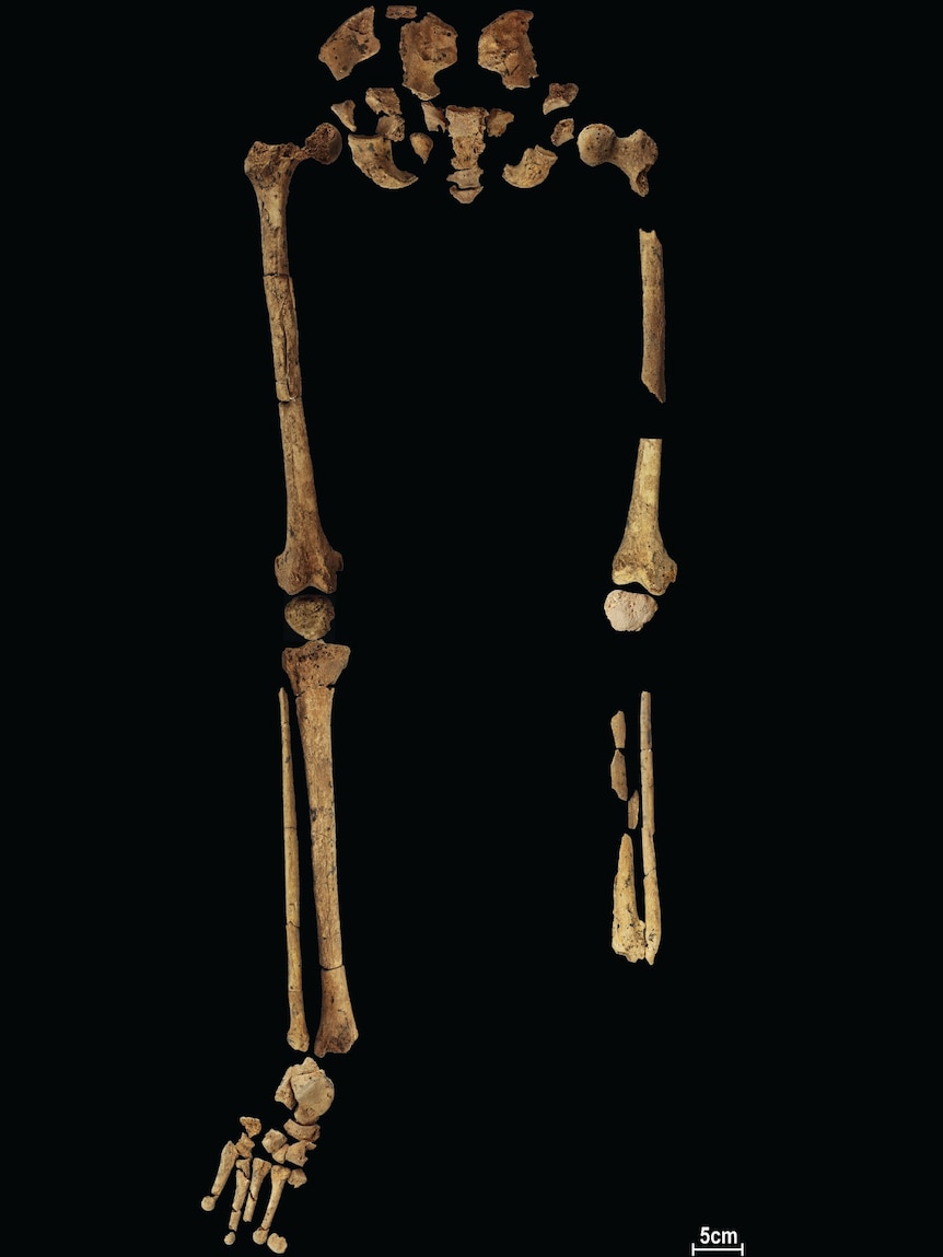 The bottom half of a skeleton that is missing its lower leg and foot