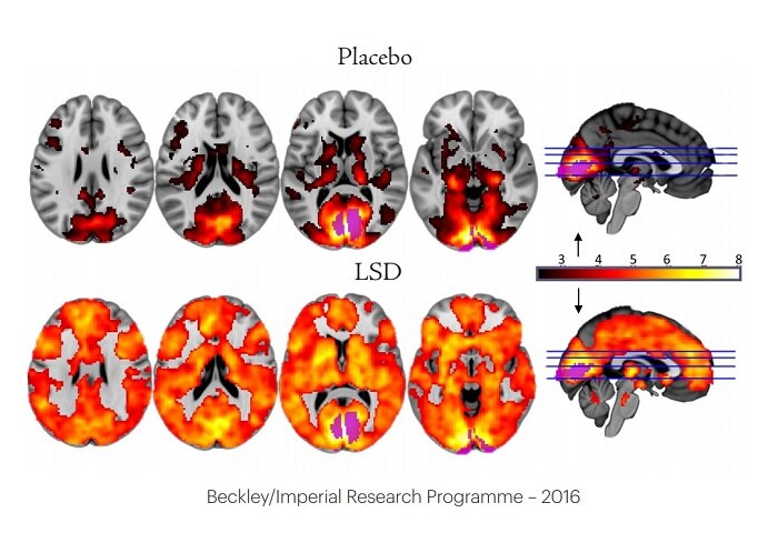 An image shows brain activity when subjects are given a placebo (top) versus LSD (bottom).