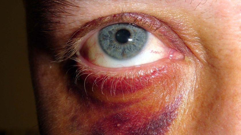 A man sports a black eye