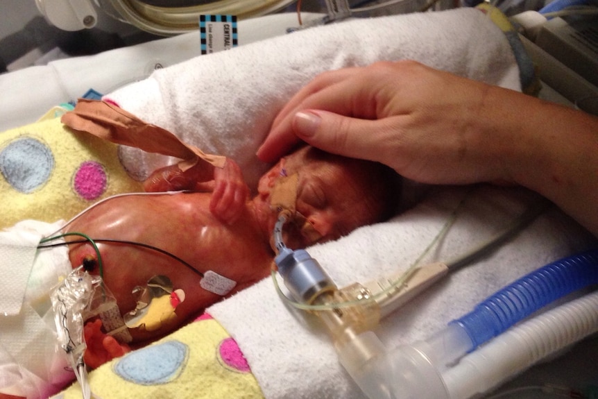 Premature baby Lexi Finnin in a humidicrib