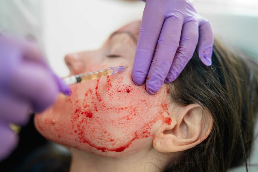 Platelet rich plasma being injected for a vampire facial treatment
