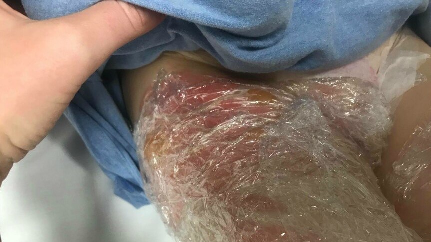 Cling wrap layered over a child's burns on upper thigh.