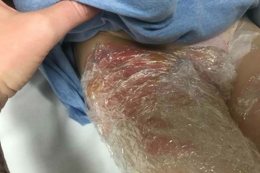 Cling wrap layered over a child's burns on upper thigh.