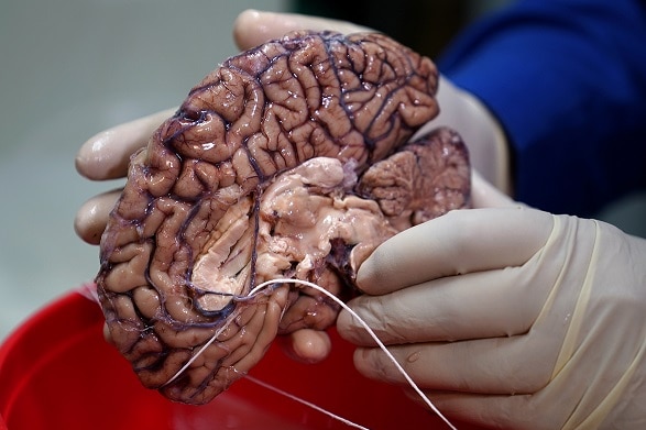 Dr. Vahram Haroutunian holds a human brain in a brain bank in the Bronx.