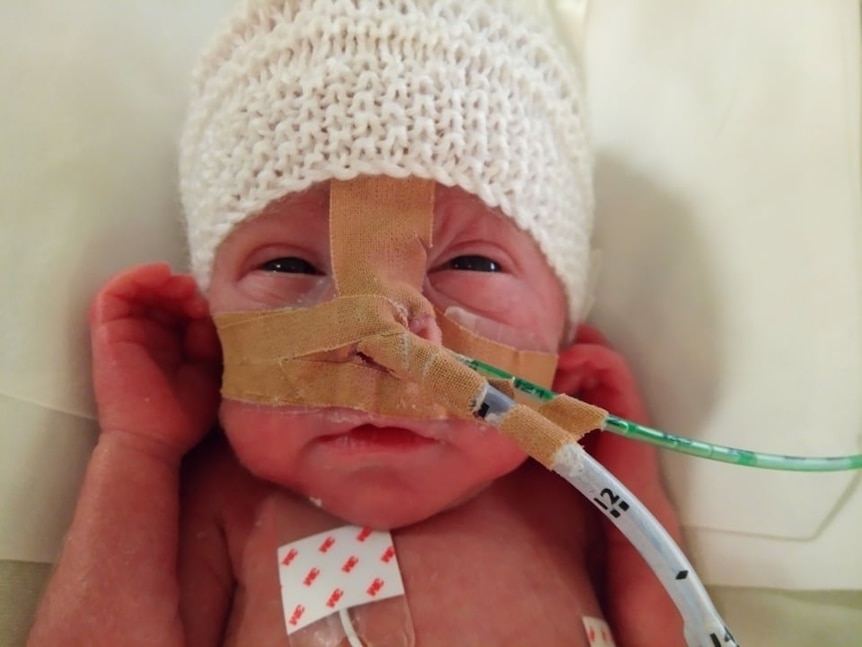 A premature baby with wires and tubes in its nose peeks at the camera