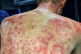 A man bends forward, showing numerous red welts on his bare back