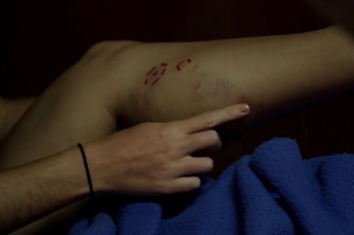 Crocodile bite mark on Melissa Marquez's calf