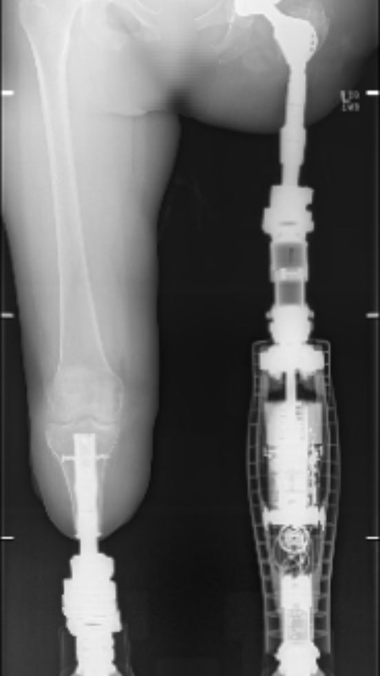 An x-ray of amputated legs with prosthetic limbs attached