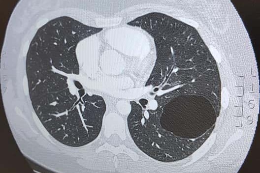 Medical scan image showing large cyst on left lung of Australian traveller Amanda McDonald.