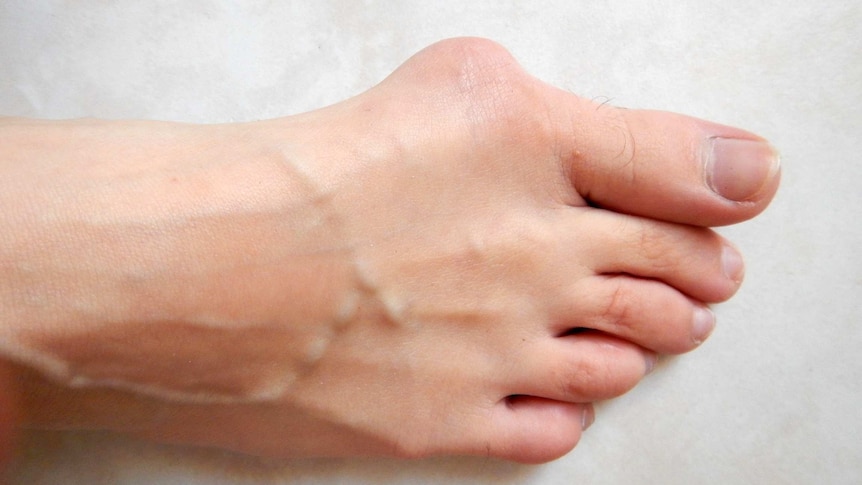 Hallux valgus or bunion in a foot