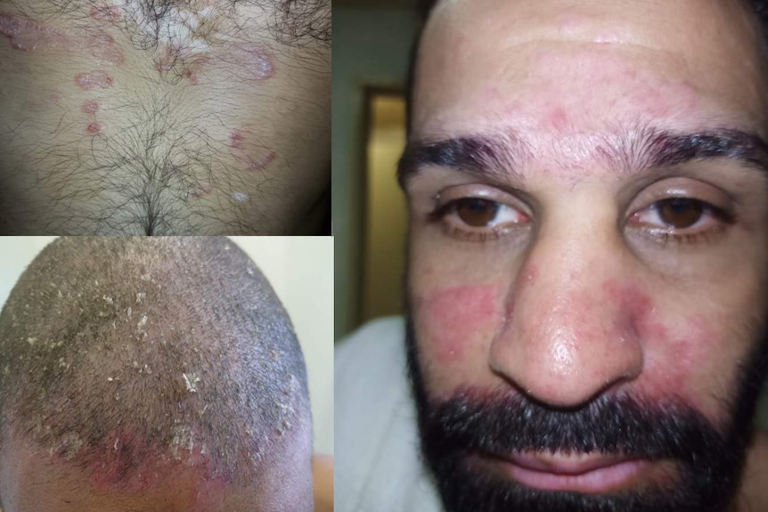 pictures of red, patchy and flaky skin on Amin's face, scalp and chest.