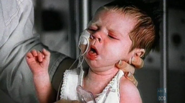 An infant with whooping cough
