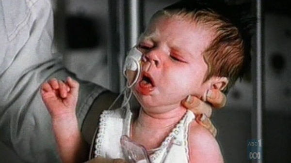 An infant with whooping cough being held