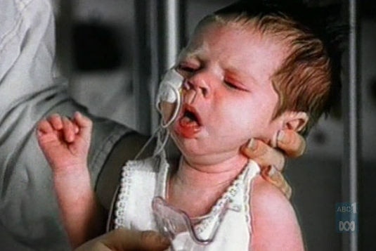 An infant with whooping cough being held