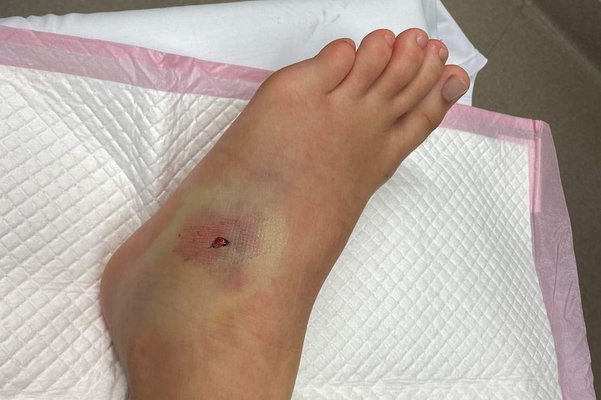 A puncture wound surrounded by bruising on a foot