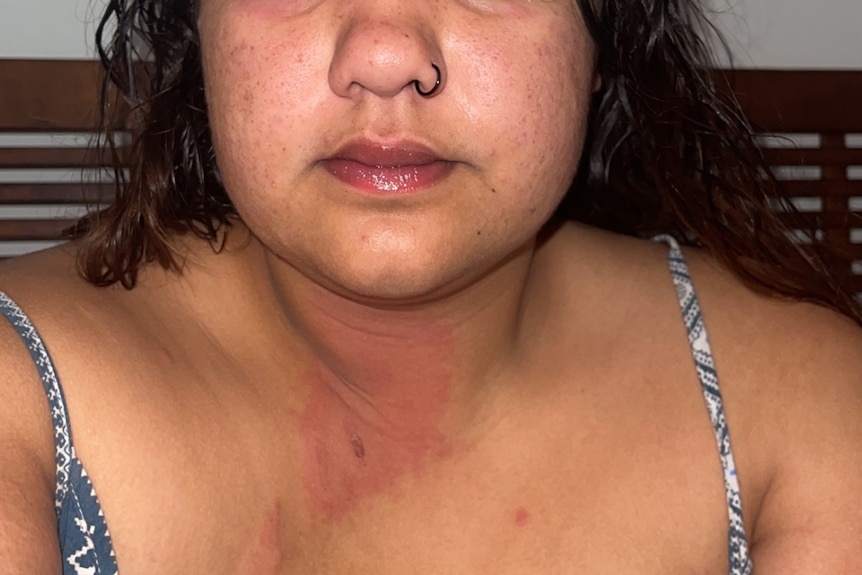 georgia carter with a red burn and rash on neck 