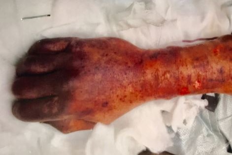 A man's hand is covered in blood spots from a rare bacterial infection his fingers are purple