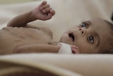 Baby in Yemen clinic