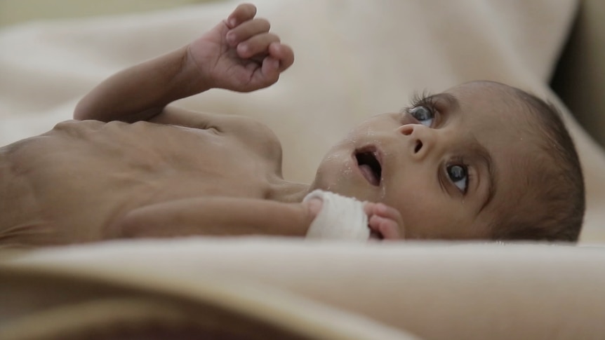 Baby in Yemen clinic