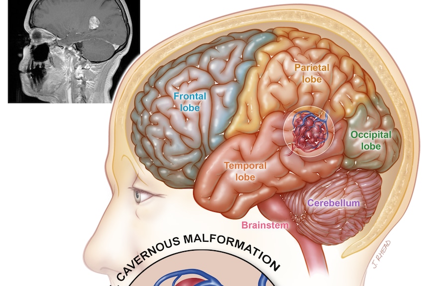 A diagram showing a raspberry-like CCM in a brain.