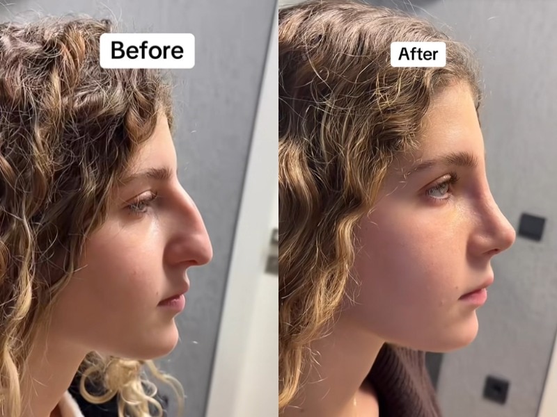 Duas fotos laterais do perfil de uma menina, antes e depois da cirurgia no nariz.