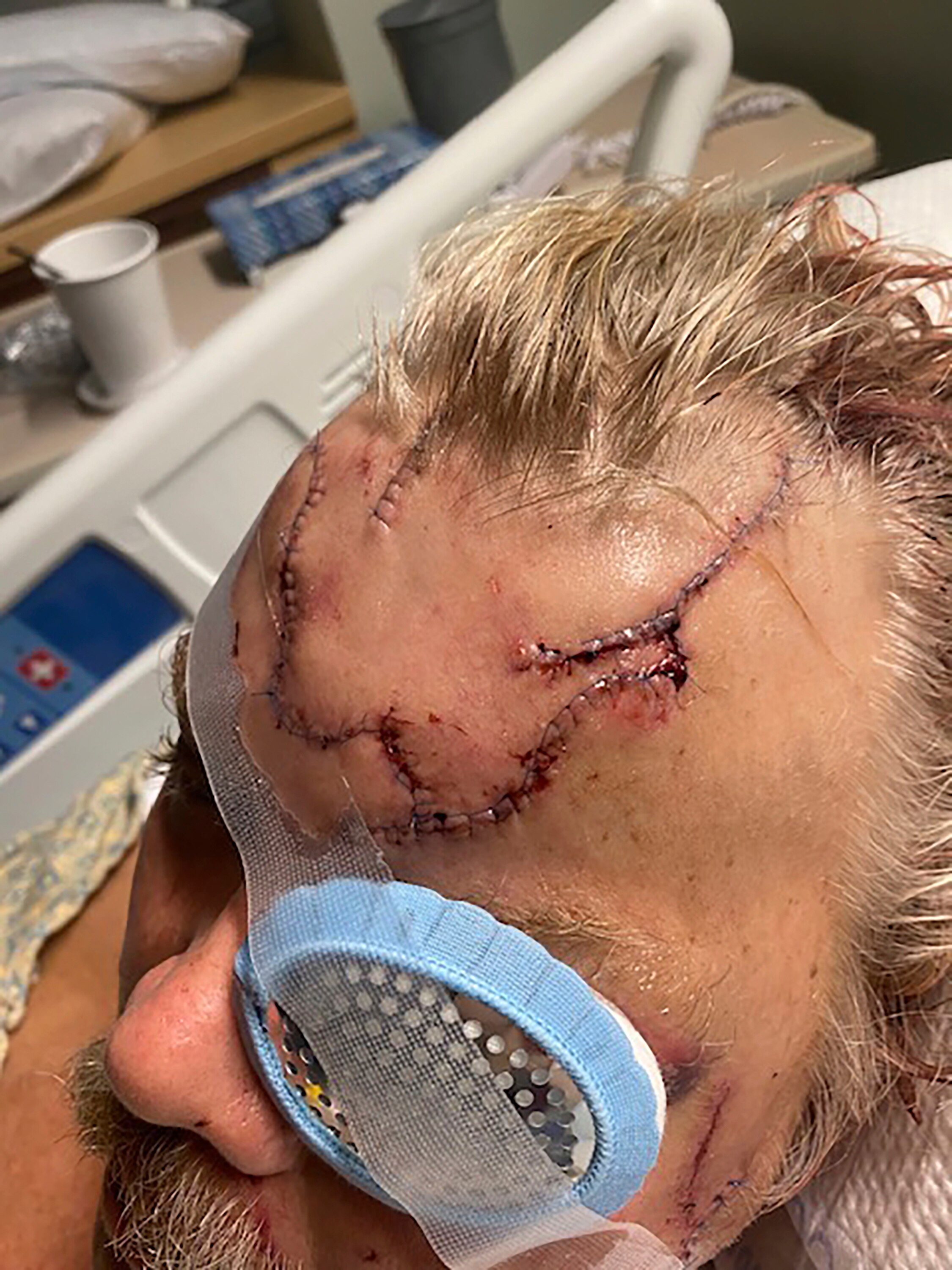 A large wound is seen across a man's head with black stitches across his scalp