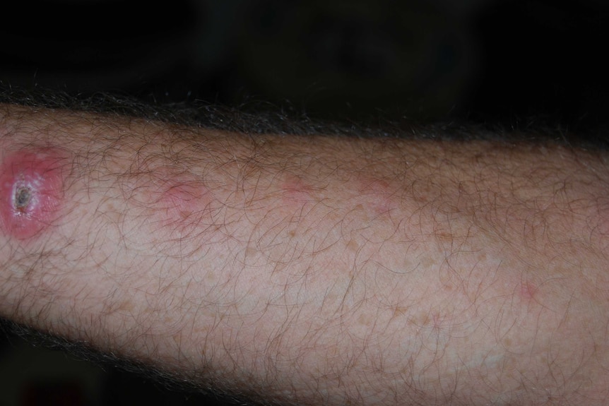 Man's arm with crusty sore and red lumps in a line on skin