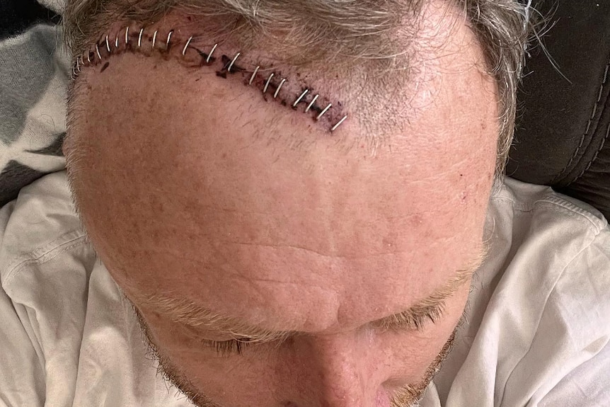 top of a man's head with scar