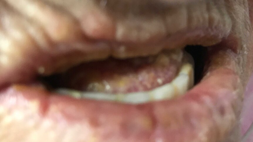 A close-up of an old woman's dehydrated mouth.