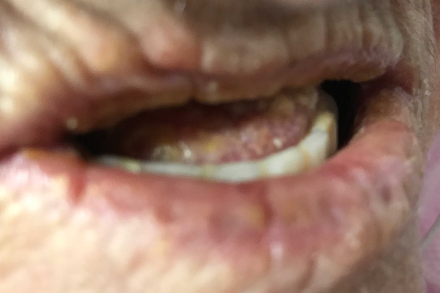 A close-up of an old woman's dehydrated mouth.