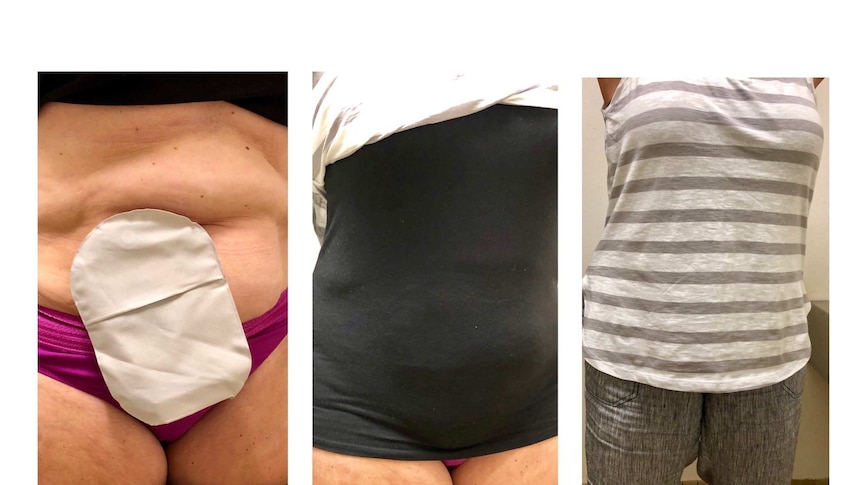 Three pictures of a woman with an ileostomy bag, singlet covering and then clothing over the singlet.