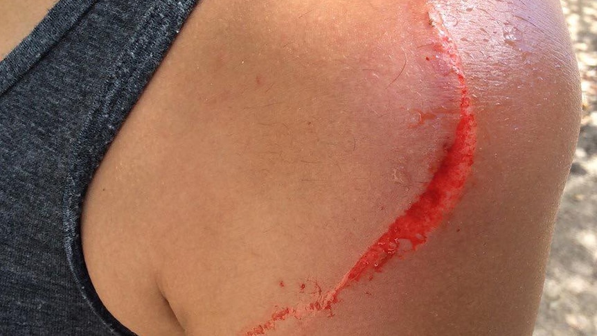 A man's shoulder with a deep gash from a kangaroo