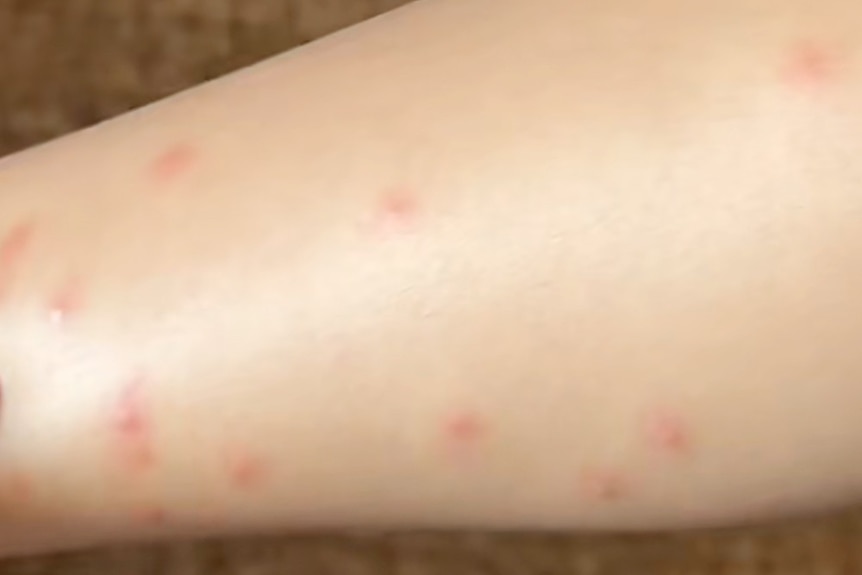 A woman's arm with several red marks on it