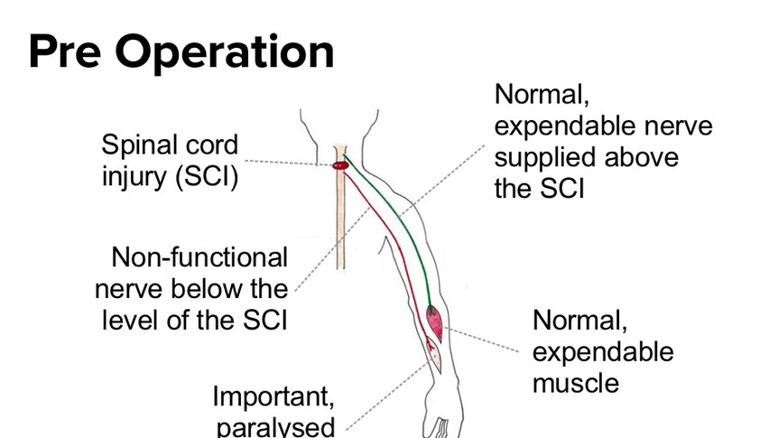 An illustration showing Jack's nerve before the operation
