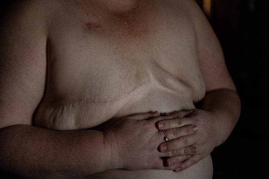 A close up of Heidi Arntzen's chest shows scars from a mastectomy that left her with excessive skin.