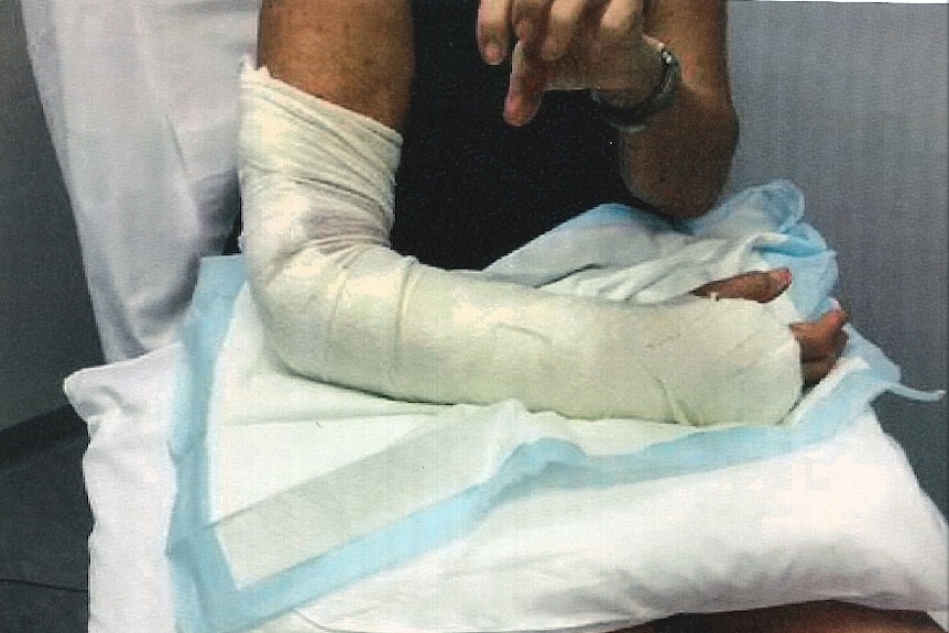 A photo of an arm in a cast.