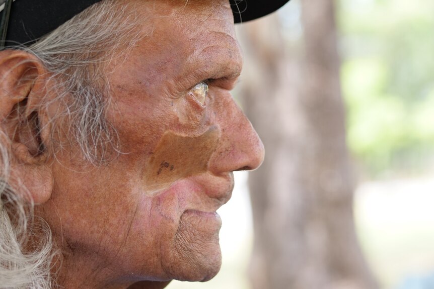 An older Indigenous man in profile, a skin graft visible.