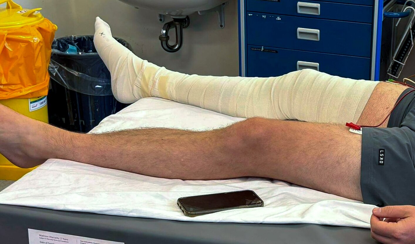 A mans legs lying in a hospital bed, the right leg is wrapped from foot to thigh in white bandage