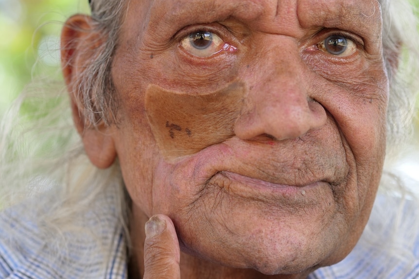 An Indigenous man points at a skin graft on his cheek.