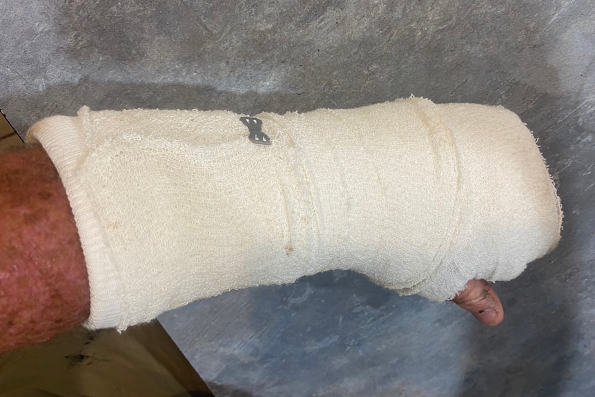 A hand in a cast.