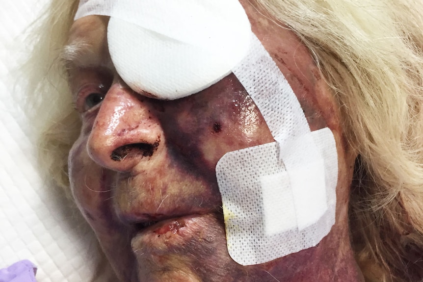 Clare Alexa Wilson, then-92, lies in a bed with facial injuries, recovering from being attacked in her home.