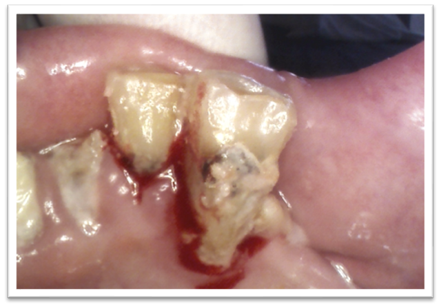A close up of a mouth with broken teeth and a gum infection